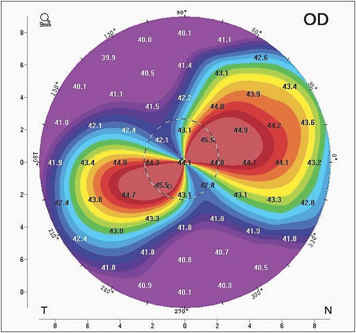 Figure 1. Peripheral astigmatism.