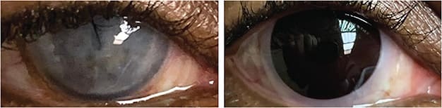 Figure 4. The eye before (left) and after (right) prosthetic lens application.