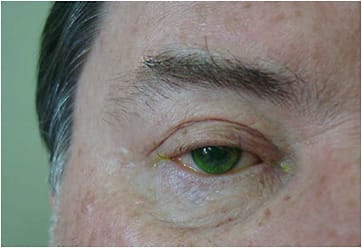 Figure 5. OD GP lens fit. This patient tends to move his lid downwards, and he is sensitive to light.