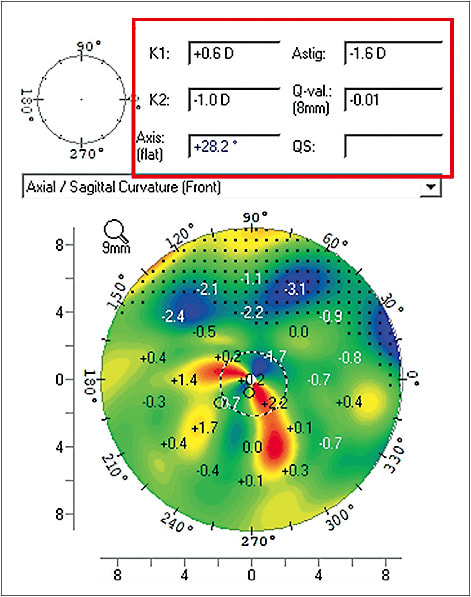 Figure 1. A difference map comparing the axial curvature map of a preoperative cataract patient who has dry eye disease before and after dry eye treatment. Note the reduction of astigmatism by 1.6D and 30º of axis change. This is the difference between selecting a monofocal or toric IOL. Without treatment, the refractive target would be missed.
