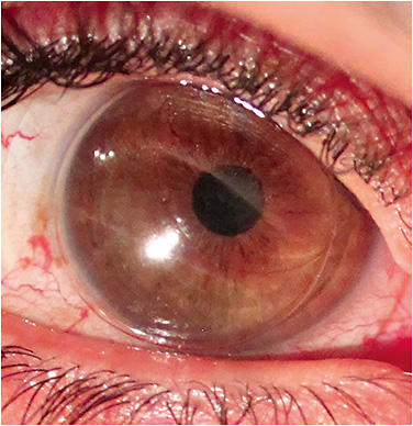 Figure 5. The optics of this lens disguise a large air bubble.