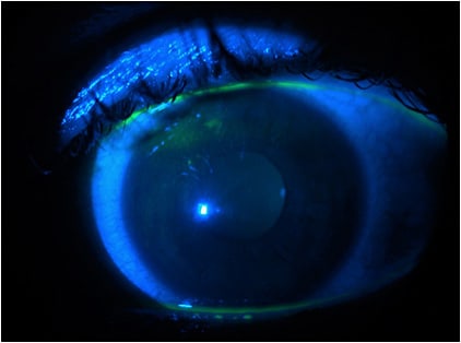 Figure 4. Corneal abrasions at the 10 o’clock to 11 o’clock position.