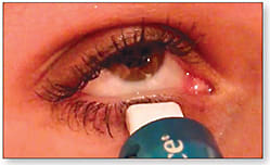 Figure 1. A calibrated meibomian gland expressor in action.