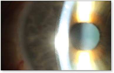 Figure 4. Post-lens tear fogging: optic section Courtesy of Dr. Jason Jedlicka