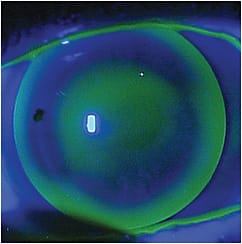 Figure 2. Flattening the BCR and reducing the BOZD provided better comfort, centration, and edge lift.