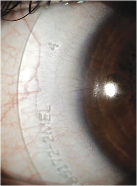 Figure 3. A quadrant-specific edge on a scleral lens.