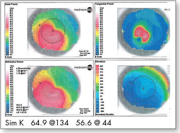 Figure 1. Patient’s topography OD before CXL.