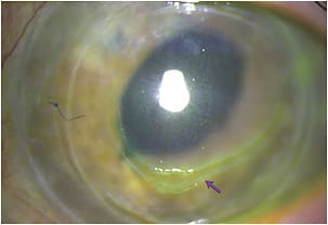 Figure 2. Marked epithelial bullae that appears in a highly compromised corneal graft after a four-hour scleral lens wear challenge. The bullae disappears following discontinuation of scleral lens wear within 24 hours post-lens wear. This patient is miserable from ocular discomfort when she does not have a contact lens on her eye.