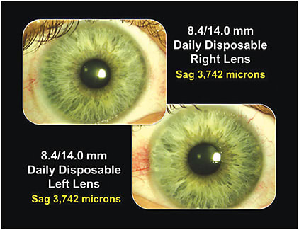 Figure 1. Patient’s right and left eyes following wear of daily disposable contact lenses.