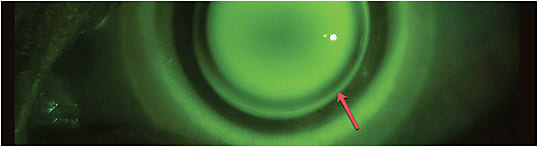 Figure 2. Fluorescein pattern of a hybrid lens on an irregular cornea. Red arrow = area of clearance at the hybrid lens junction.