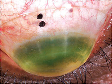 Figure 2. A scleral lens on an eye following penetrating keratoplasty.
Photos courtesy of Tom Arnold, OD