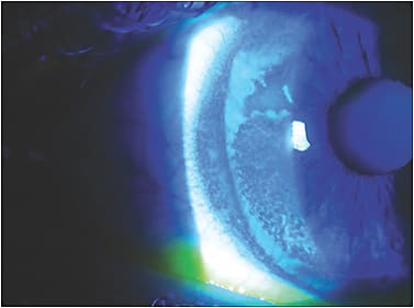 Figure 4. Epithelial staining secondary to a scleral lens that was bearing on the limbus.