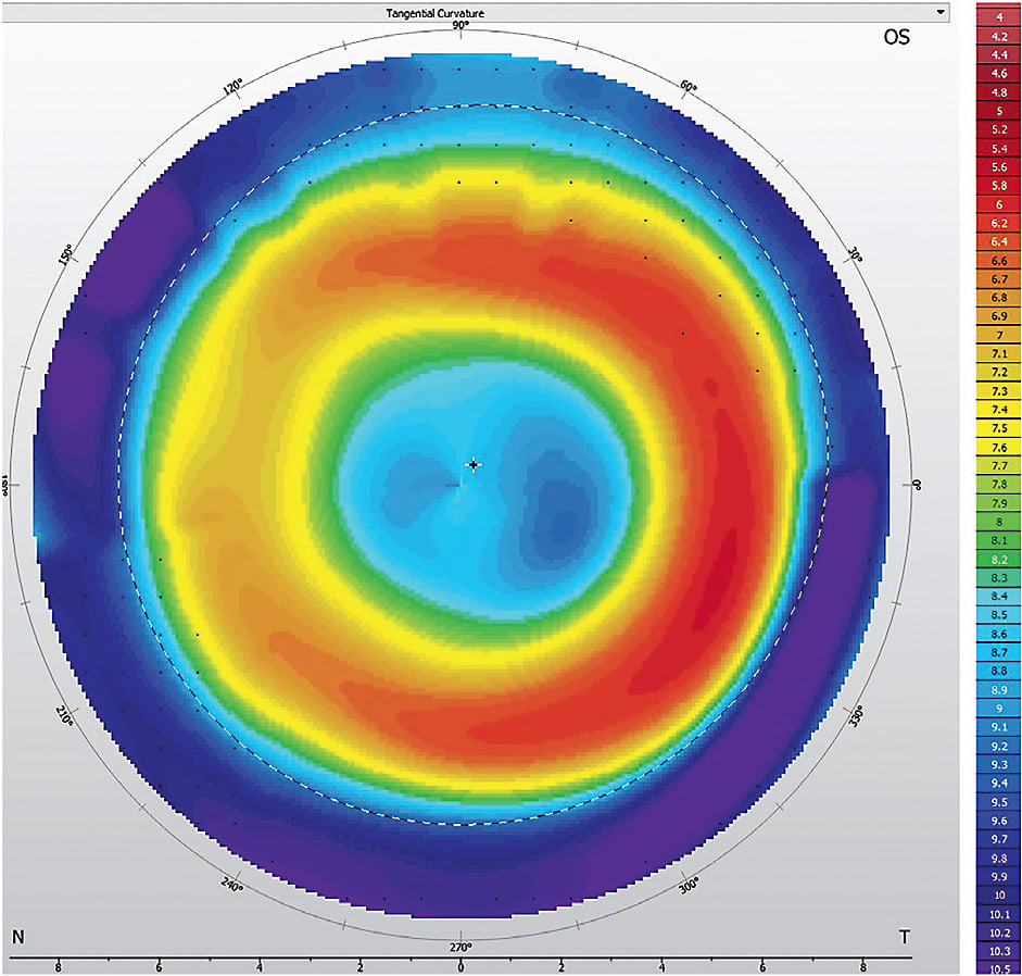 Figure 3. Tangential map demonstrating proper centration.