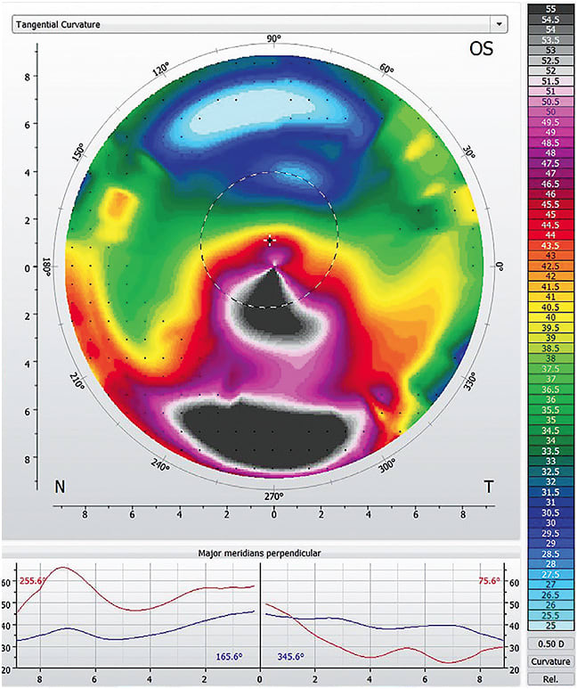 Figure 1. Corneal shape following both corneal cross-linking and intracorneal ring segment implantation.Image courtesy of Roxanna T. Potter, OD.