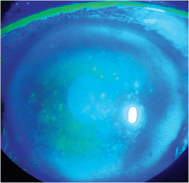 Figure 1. Severe diffuse superficial punctate keratitis resulting from dry eye disease.
Photos courtesy of Tom Arnold, OD