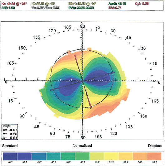 Figure 5. The same eye as in Figure 4. The cylinder now has reached 9.36D. Perhaps more important is the overall shape of the graft. Much more pronounced ectasia is discernible in the areas in which both corneal and scleral lenses abrade.