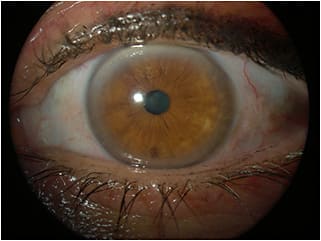 Figure 2. Slit lamp observation OS.