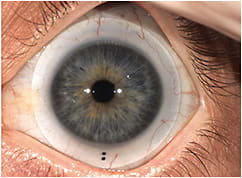 Figure 2. Empirical lens fitting over a complicated ocular surface. Photo courtesy of Aaron Wolf, OD