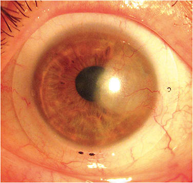 Figure 8. A customized free-form scleral lens provided the best match with the scleral shape.