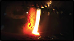Figure 4. Severe corneal neovascularization OS.