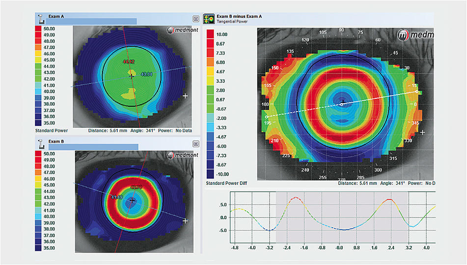Figure 2. A well-centered myopic orthokeratology lens will result in a red ring that is concentric with the pupil on a tangential difference map.
