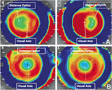 Figure 3. Decentered optics in multifocal lenses are a technological advancement improving the visual experience for lens wearers. Image courtesy of Matt Lampa, OD