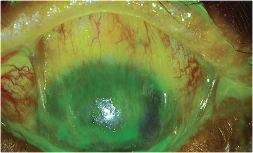 FIGURE 3. Symblepharon in a patient who has SJS. Photo courtesy of Gloria Chiu, OD.