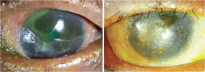 FIGURE 7. Keratinization of the conjunctiva (A) and entire cornea (B). Photos courtesy of Gloria Chiu, OD.