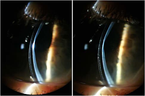 Figures 2. Slit lamp cross-section view showing the nebula and the thinning at the apex.