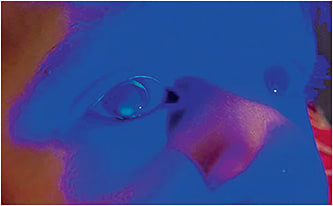 Figure 2. Corneal GP lens on the child&amp;#x2019;s right eye.