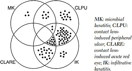 Figure 2. Venn diagram showing how the 111 corneal infiltrative events observed in the Manchester Keratitis Study were classified according to the criteria of Sweeney et al.16 Each dot represents a single corneal infiltrative event. Thirteen corneal infiltrative events are not shown because they did not fit into any category.&amp;#xA;Reprinted from Efron and Morgan20 with permission of Lippincott Williams &amp;amp; Wilkins.