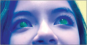 Figure 2. Scleral contact lenses can correct highly astigmatic children who are active in sports.