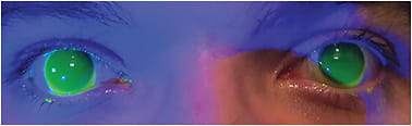 Figure 6. Scleral lenses can be designed with center-distance multifocal optics for myopia management.