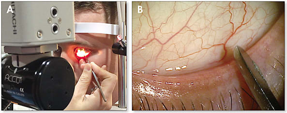 Figure 3. Debridement of the lid margin at the slit lamp (A), and as seen through the slit lamp (B).