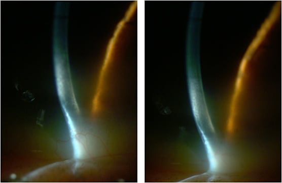 Figure 4. The inferior peripheral cornea OD and OS viewed with slit lamp magnification.