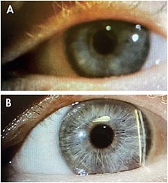 Figure 1. Mild aponeurotic blepharoptosis OS (A); Significant upper lid elevation approximately 30 minutes after one drop of Upneeq ophthalmic solution (B).