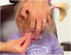 Figure 1. Young patients can wear scleral lenses with topical medication in the bowl of the lens for healing.Photo courtesy of Melanie Frogozo, OD.