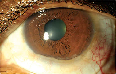 Figure 14. Conjunctival prolapse.