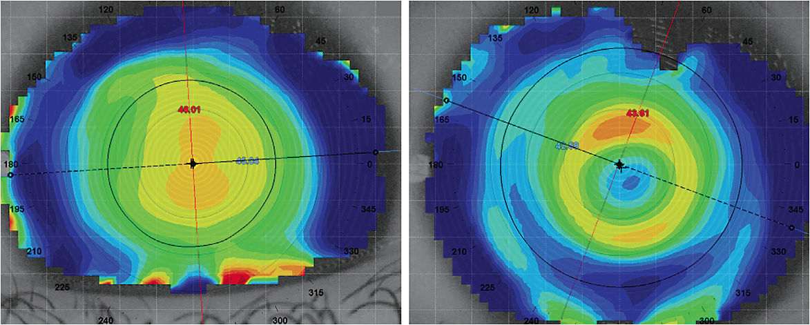 Figure 1. Corneal topography can be taken over the multifocal soft lens on eye to examine the centration and size of the multifocal optic. Topography of a myopic pediatric patient without a contact lens (left) and after a high-add soft multifocal is fitted onto the eye (right).