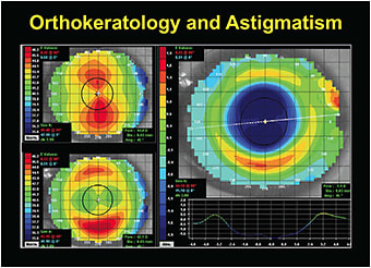 Figure 1. The central treatment curve makes the cornea more spherical and eliminates the patient’s astigmatism.