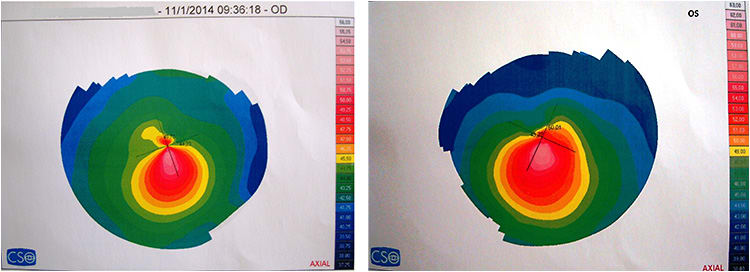 Figure 2. Corneal topography OD and OS obtained in 2014.