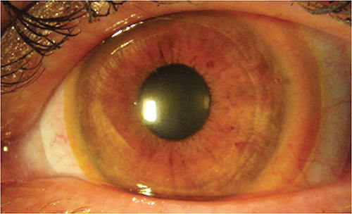 FIGURE 6. Yellow-tinted soft contact lens under the scleral lens to reduce indoor light hypersensitivity.Image courtesy of Gregory W. DeNaeyer, OD.