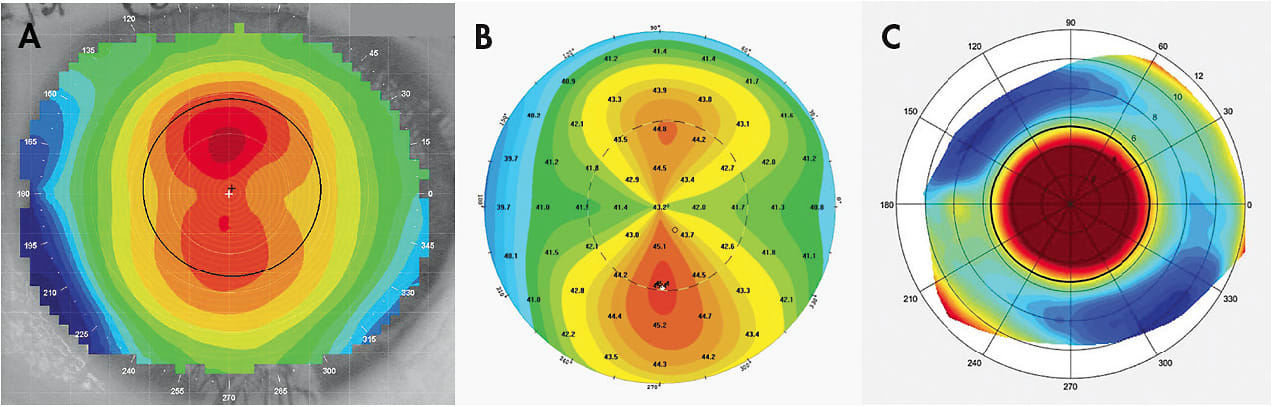 Figure 1. Corneal topography image demonstrating A) central astigmatism, which is usually limited to the central 3mm to 6mm of the cornea (Image courtesy of Randy Kojima, Patrick J. Caroline, and John Mountford); B) limbus-to-limbus astigmatism, which usually extends beyond 6mm to the limbus of the cornea; and C) Scleral topography exhibiting a regular toric scleral shape.
