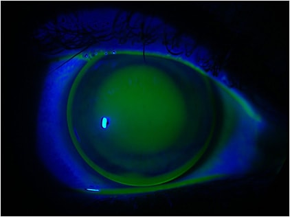 Figure 5. Fluorescein pattern view of right eye refit.