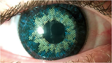 Figure 4. Piggyback lens system on a keratoconus patient who has an 8mm mesopic pupil. A corneal GP lens overlays a prosthetic soft lens with a black opaque underprint and 4.0mm clear pupil to reduce residual aberrations in dim illumination.