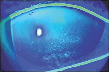 Figure 1. Three days post-bandage lens wear. There is significant diffuse corneal staining and an inferior linear epithelial lesion consistent with exposure keratopathy.