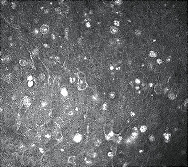 Figure 4. Double-walled cysts are seen in this confocal microscopy image of a cornea with Acanthamoeba keratitis. Photo courtesy of the Francis I. Proctor Foundation/UCSF.