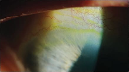 Figure 8. Vascularization along the superior limbus. The lens material has a Dk of 141, a lens thickness over the limbus of 0.35mm, and a tear lens thickness of 30 microns.
Image courtesy of Steve Byrnes, OD.