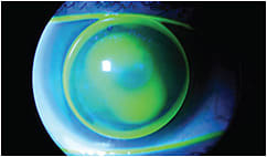 Figure 2. A spherical corneal GP lens on a keratoconic cornea.