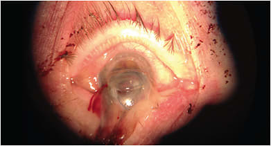 FIGURE 2: Note the prominent apical corneal thinning from advanced KCN while the patient was in a partially supine position. IMAGE COURTESY W. BARRY LEE, MD, FACS